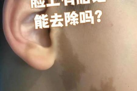 脸上胎记算命看出命运