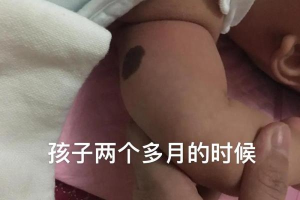 胳膊胎记算命